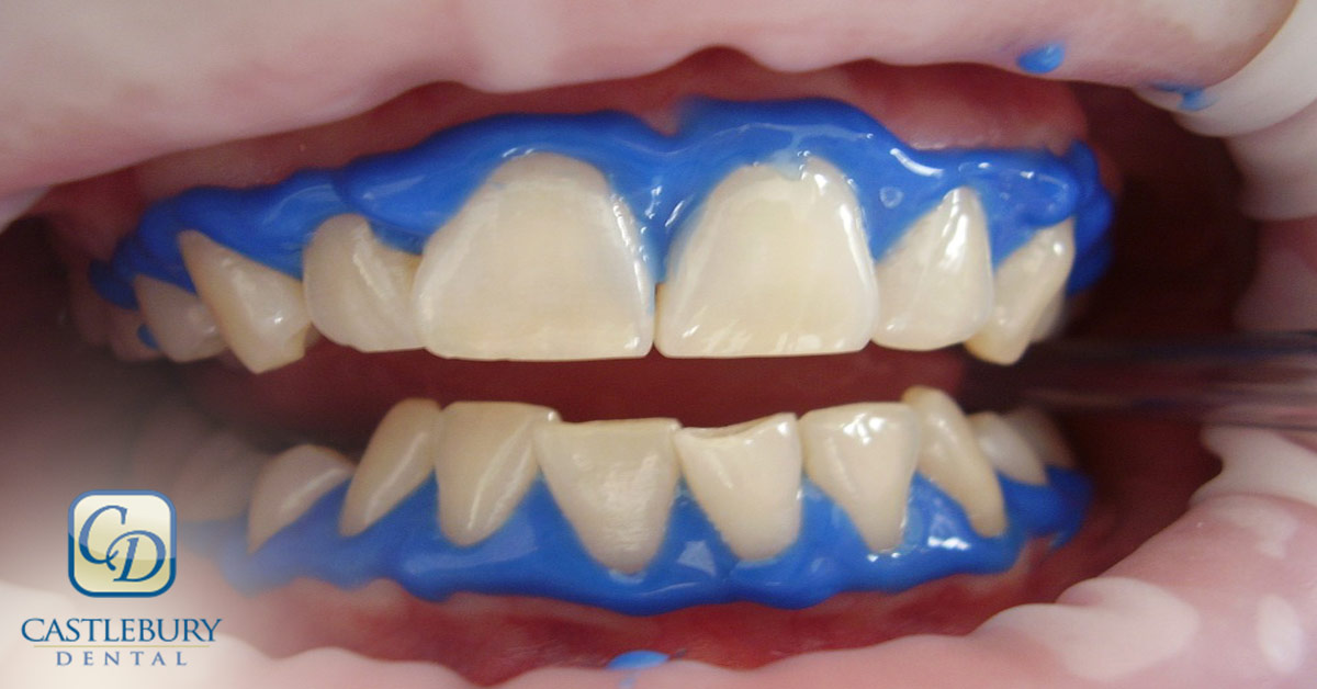 What Are My Options for Teeth Whitening?