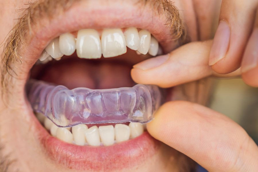 a man inserting Invisalign into his mouth
