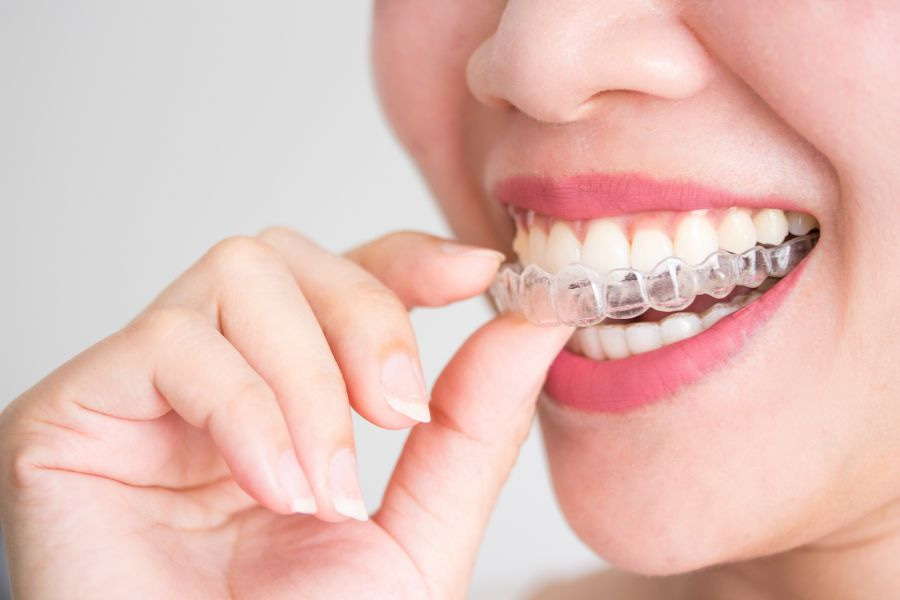 woman inserting Invisalign clear aligners into her mouth