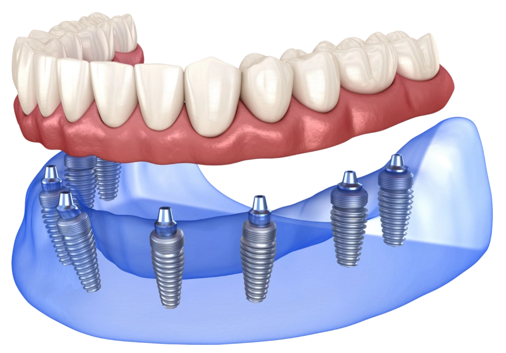 dental implants Eagle