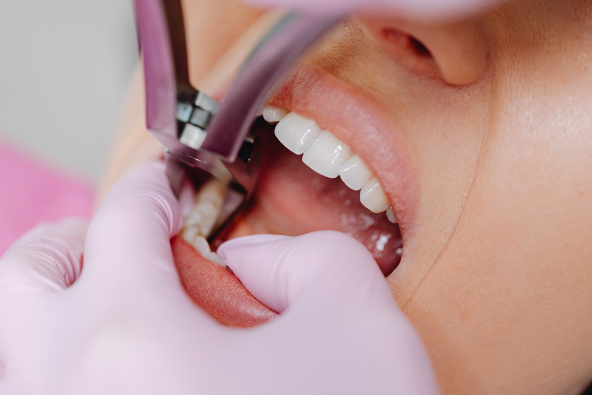 tooth extractions eagle