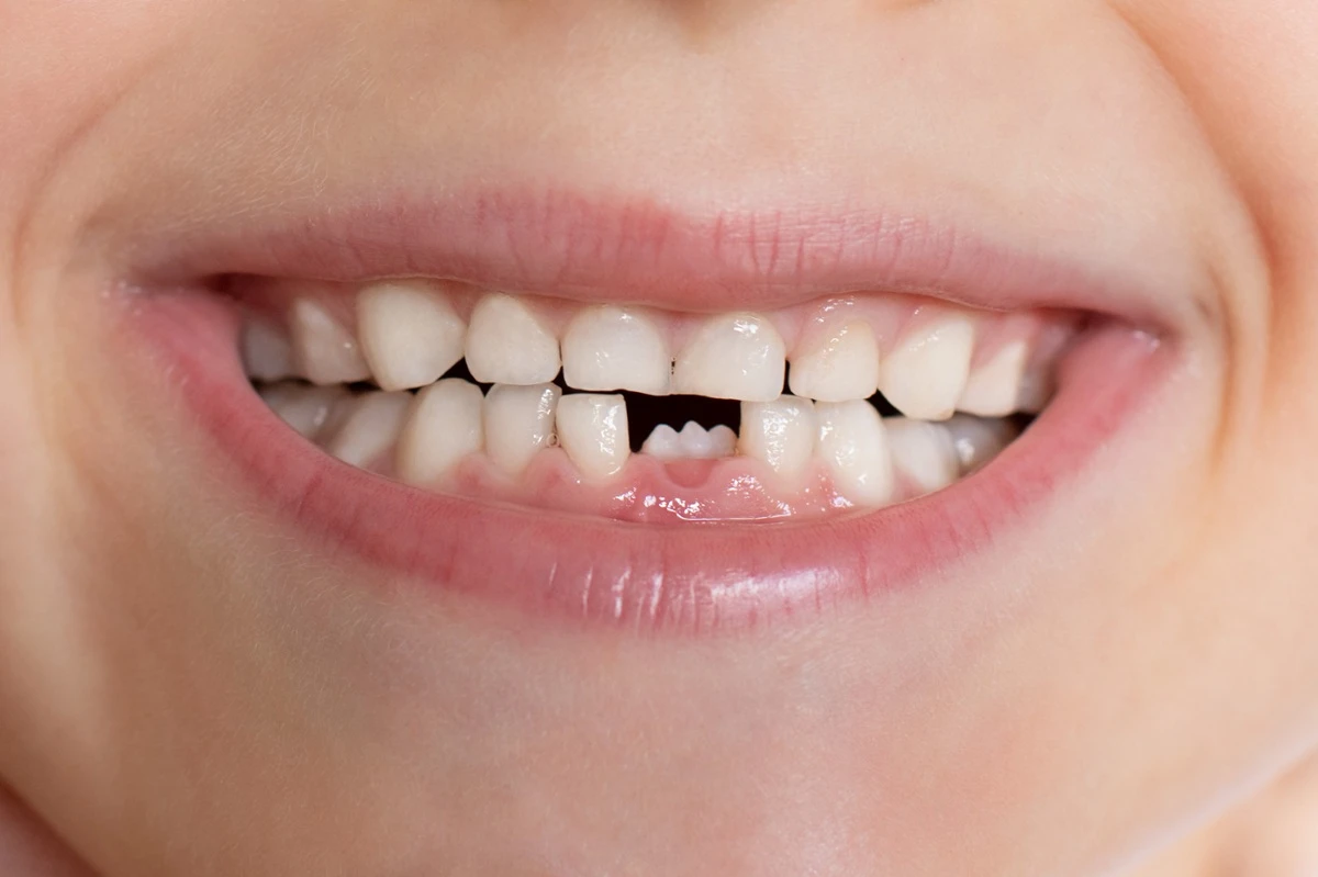 normal socket after tooth extraction