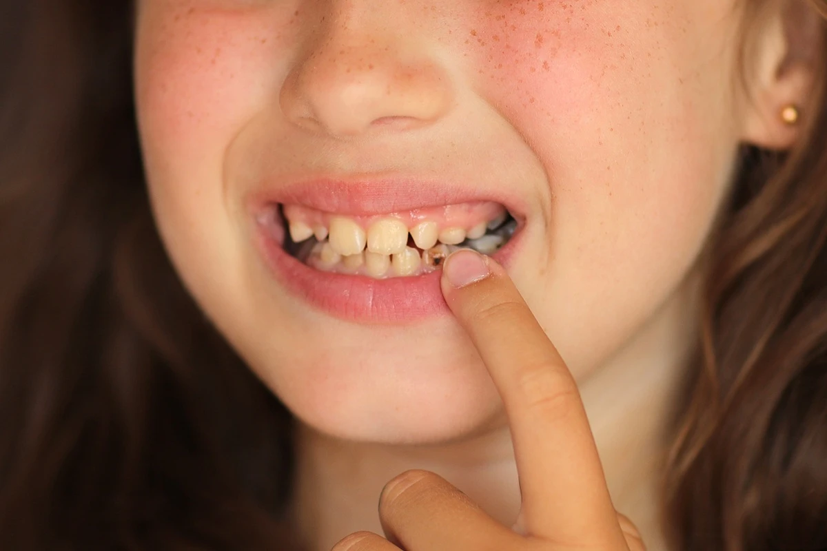 little girl opens her mouth shows tooth cavity