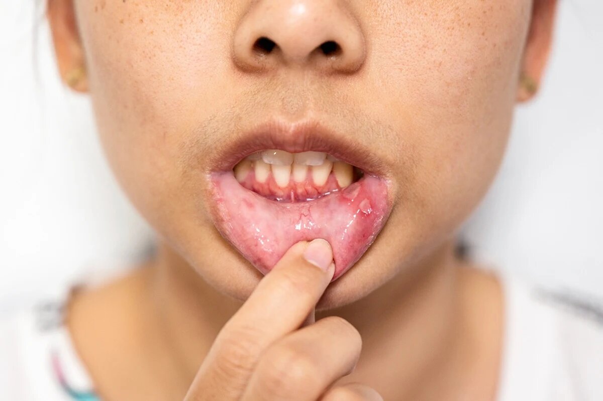 Child Gums Red and Swollen