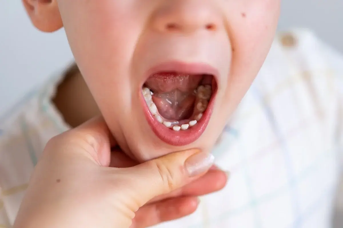 Toddler showing open mouth with primary teeth during dental examination.